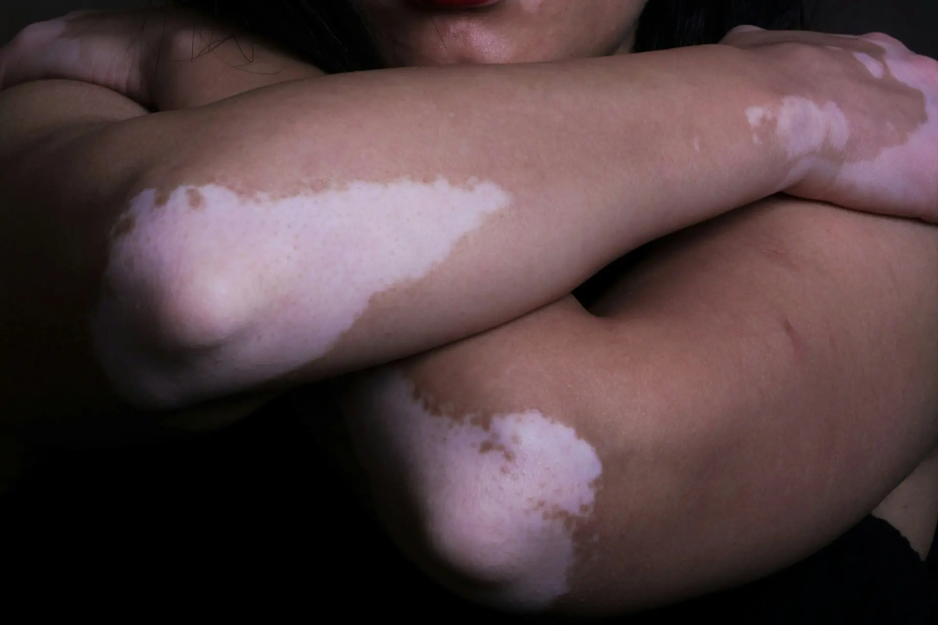 patiente atteinte de vitiligo